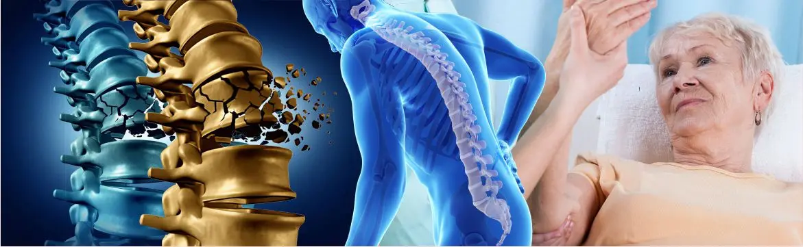 Osteoporosis Management